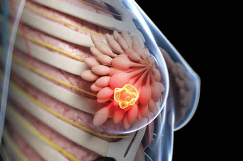 هشدارجدی: روزانه ۴۰ زن در ایران به سرطان پستان مبتلا می‌شوند