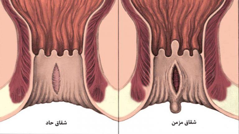 شقاق مقعدی چیست؟ شکل فیشر در زنان، مردان و کودکان