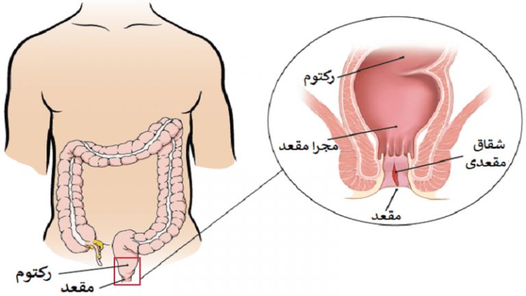 شقاق مقعدی چیست؟ شکل فیشر در زنان، مردان و کودکان