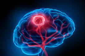 ادرار و تشخیص تومور مغزی