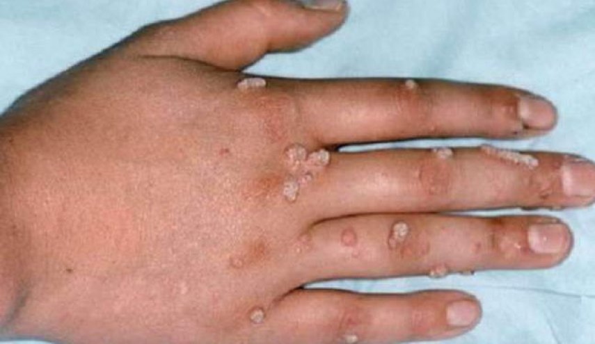 همه چیز در مورد «آبله میمون»