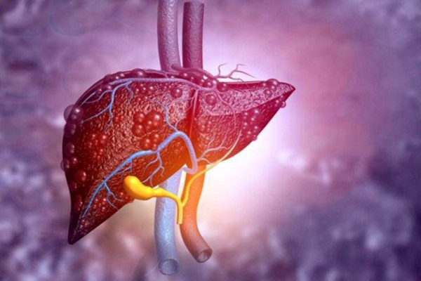 آیا «کبد چرب» بیماری خطرناکی است؟