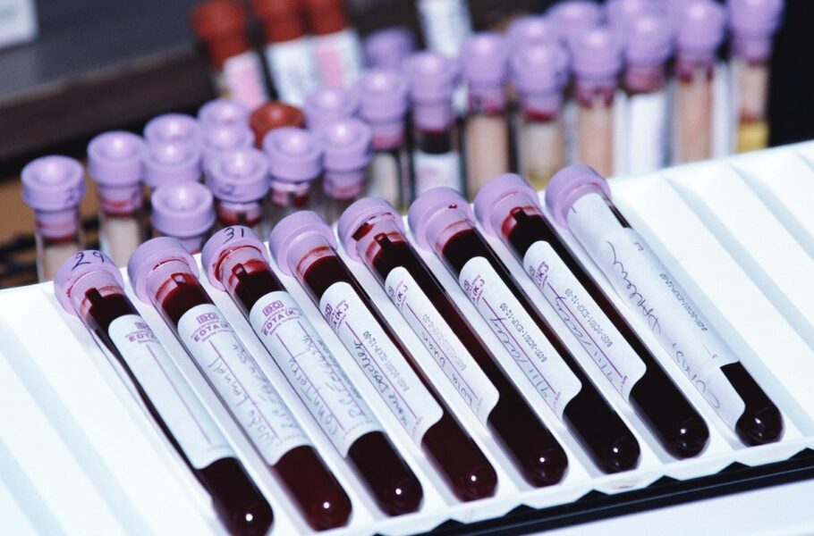 تشخیص زودهنگام انواع سرطان با یک آزمایش خون ساده