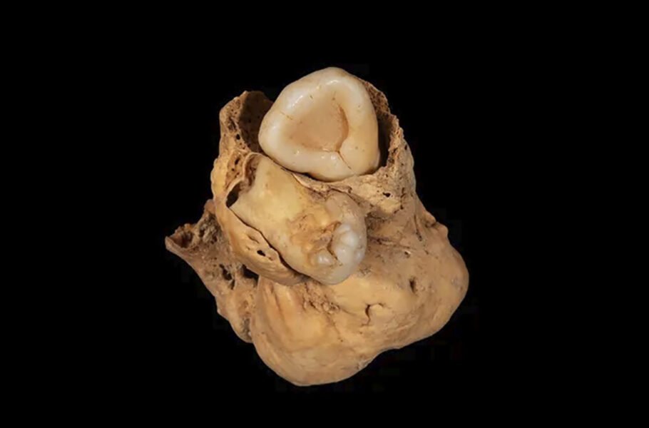 توموری عجیب در فسیل ۳۰۰۰ ساله زن مصری