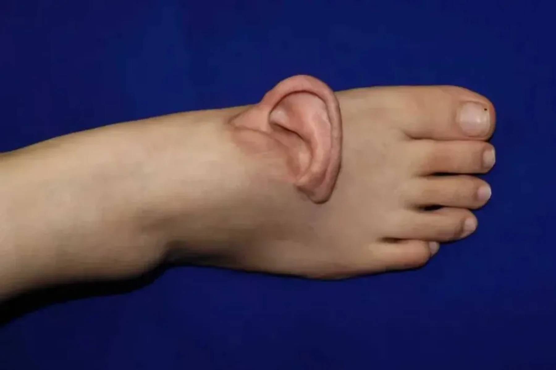 پیوند شگفت‌انگیز گوش به پا!