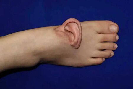 پیوند شگفت‌انگیز گوش به پا!