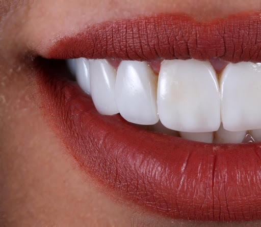 افزایش هزینه لمینت دندان به دلیل رشد قیمت مواد وارداتی و خدمات تخصصی
